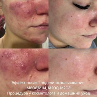 Биосыворотка АНА 6% Vedara Medical 